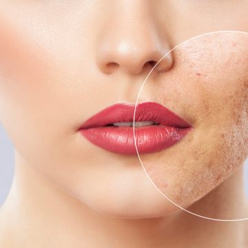 Laser Acne Treatment