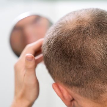 Erkeklerde Saç Dökülmesi ve Ekim Seçenekleri