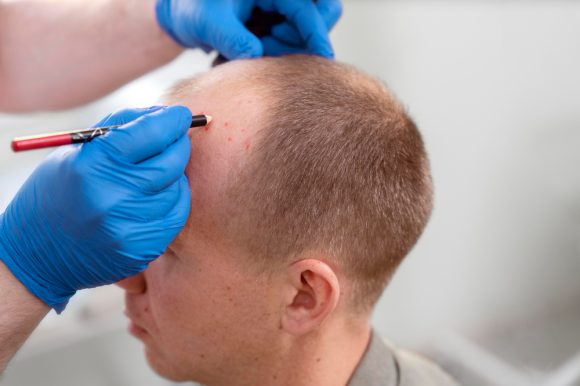 Otolog Saç Ekimi: Modern Teknoloji ile Doğal Görünümlü Saçlara Kavuşun