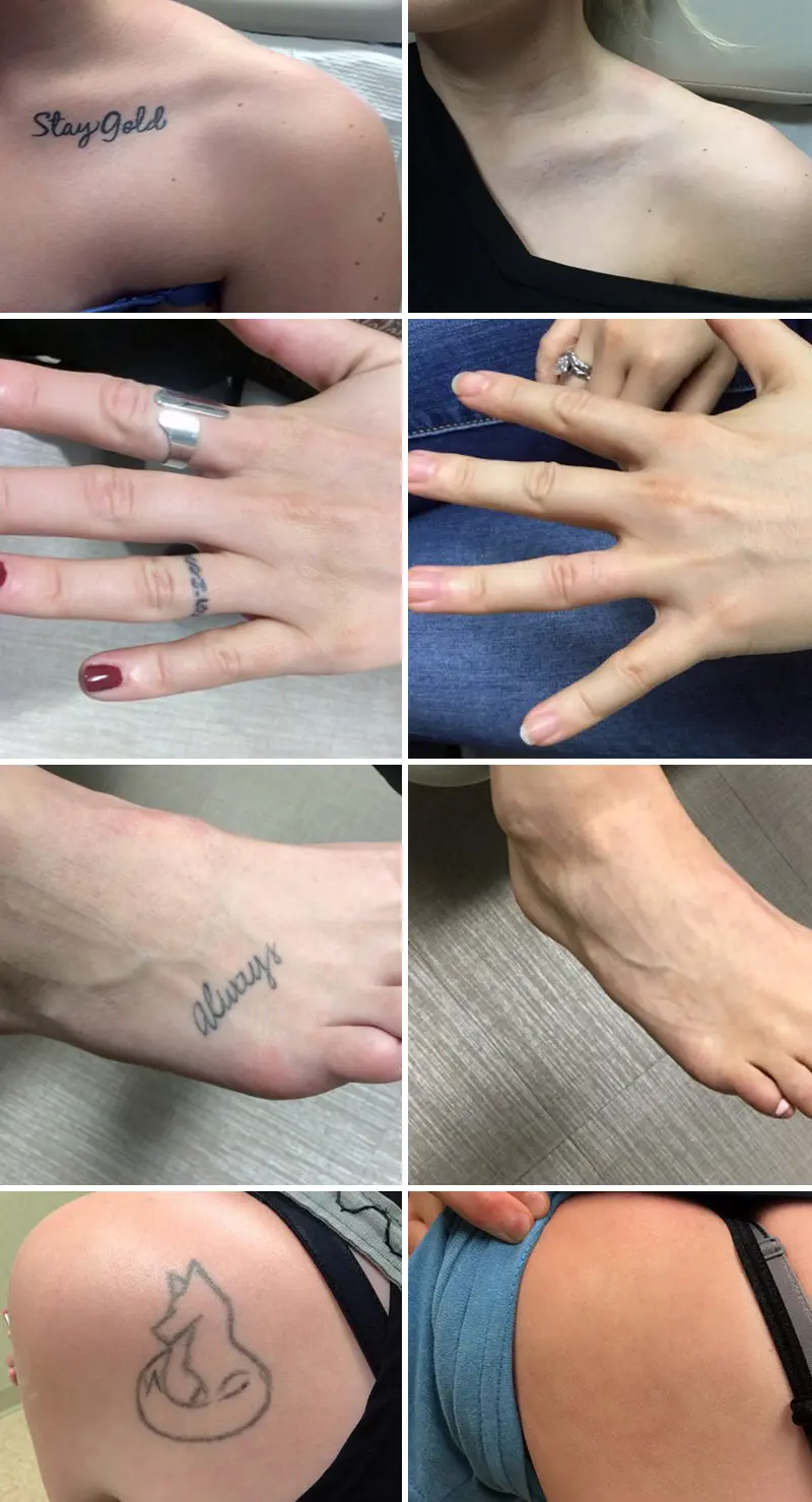 pico lazer dövme sildirme fiyatları izmir