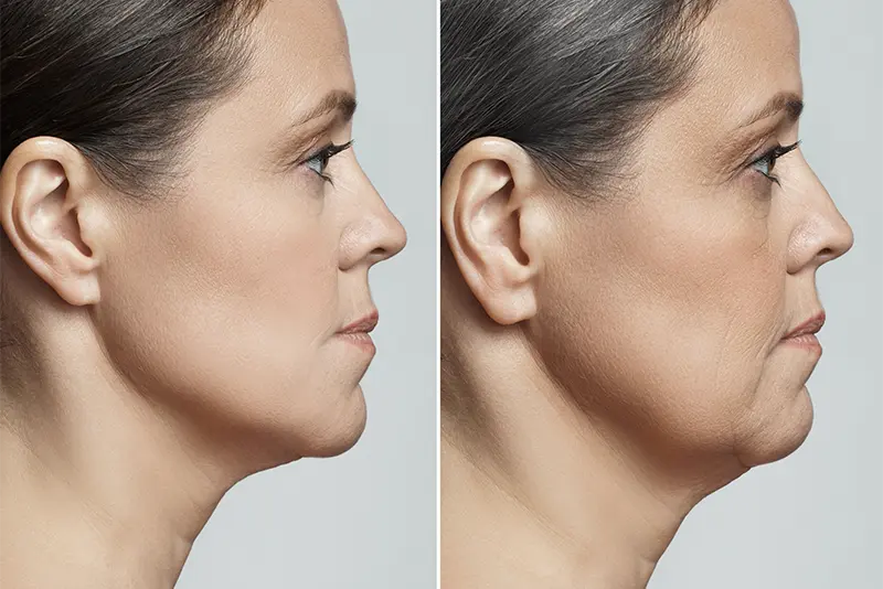 scarlet altın iğne fiyatları izmir